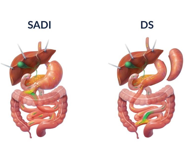 >SADI vs DS: Which One is Better?